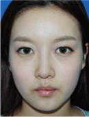 韩国清潭优整形外科-面部自体脂肪填充+玻尿酸隆鼻过程真人日记分享