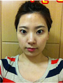 韩国巴诺巴奇整形外科-Vline+全脸面部填充整形恢复效果真人日记