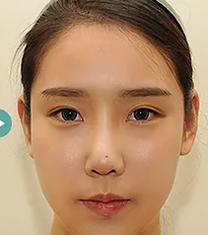 韩国TS整形外科-韩国TS整形医院双眼皮修复案例