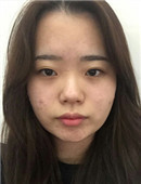 韩国麦恩整形外科-网友分享韩国眼综合+鼻综合整形真实全过程