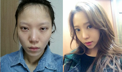 韩国灰姑娘整形外科眼鼻整形案例