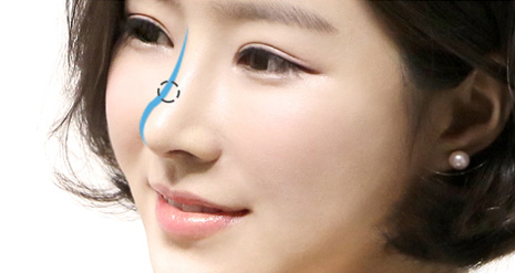 韩国灰姑娘整形外科隆鼻技术