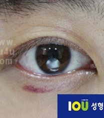韩国iou整形外科-韩国iou整形外科上眼睑下垂矫正案例对比图