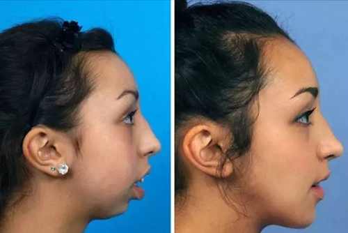 垫下巴手术能改变一个人的脸型吗？