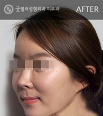 韩国GOOD FILLER（高菲乐）整形医院玻尿酸填充面部对比图