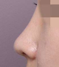 高诺鼻CONOPI整形外科-韩国高诺鼻CONOPI整形外科医院隆鼻案例对比图