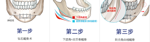 在下颌角手术中，如何使术后效果更自然