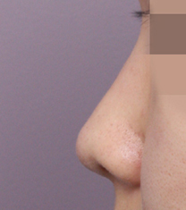 韩国高诺鼻CONOPI整形外科医院隆鼻案例对比图