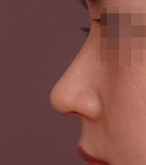NJH卢钟勋整形外科医院驼峰鼻矫正案例对比图