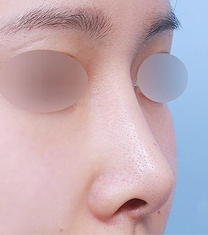 韩国朱诺整形外科短鼻矫正案例对比图_术前