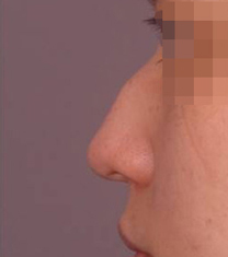 NJH卢钟勋整形外科医院驼峰鼻矫正案例对比图