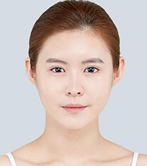 爱琳整形外科-爱琳整形外科面部轮廓成型案例对比图