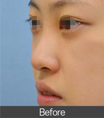 秀梦HUMAN整形外科医院隆鼻案例对比图