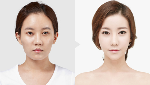 韩国面部轮廓案例正面对比