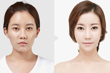 赴韩做面部轮廓整形，有哪些技术优势？