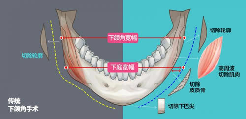 传统下颌角手术和先进下颌角手术对比