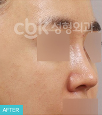 韩国CBK整形外科鼻部修复手术案例对比图_术后