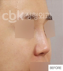 韩国CBK整形外科鼻部修复手术案例对比图