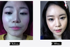国字脸3套整形方案曝光，有一种曾风靡韩国！