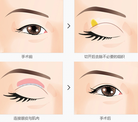 韩国做双眼皮手术在细节上有哪些不同？