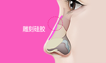 韩国做假体隆鼻展示