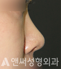 颜说整形外科鼻部矫正案例对比图