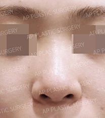韩国AP整形外科医院隆鼻案例对比图