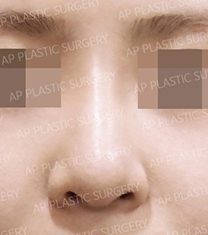 韩国AP整形外科医院隆鼻案例对比图