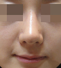 韩国I-STAR整形歪鼻矫正案例对比图
