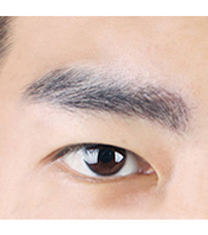 妃美整形医院-韩国BE&ME（妃美）整形医院眉毛移植案例对比图