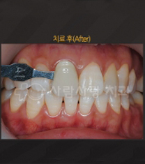 人爱首尔牙齿科医院牙齿美白案例对比图