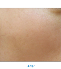 EUN皮肤科祛斑案例对比图