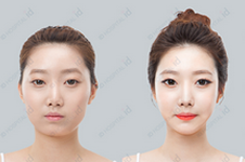 韩国T字型截骨有哪些优势，对脸型改动大吗？