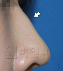 美&美微整形皮肤科鼻整形案例对比图