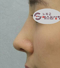 韩国SONE整形外科-韩国SONE整形外科驼峰鼻矫正案例对比图