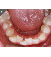 UC江南牙科牙齿矫正案例对比图
