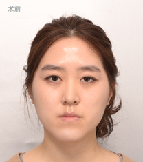 韩国爱宝（Everm）整形医院双鄂手术日记对比图