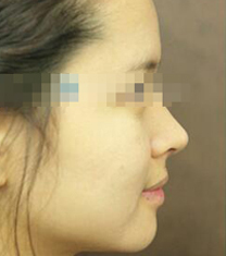 韩国trend整形医院鼻整形案例对比图