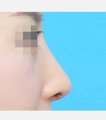 韩国ICON整形医院-韩国ICON（图标）整形医院驼峰鼻矫正案例对比图