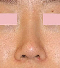韩国爱美（IMI）整形医院歪鼻矫正案例对比图