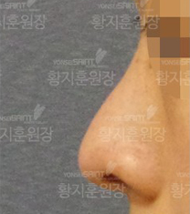韩国延世Saint整形医院隆鼻案例对比图