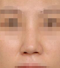 韩国Cocoline整形歪鼻矫正案例对比图