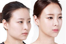 韩国下颌角整形手术大概需要多少钱？