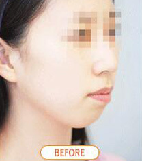 韩国Orange（橙色）整形医院凸嘴手术案例对比图
