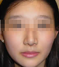 韩国颂富莱尔整形医院-韩国颂富莱尔整形医院鼻头缩小案例对比图