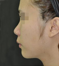 韩国美艺整形医院隆鼻案例对比图
