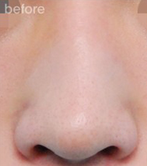 韩国三星梦整形医院-韩国三星梦（SamsungDream）整形医院歪鼻矫正案例对比图