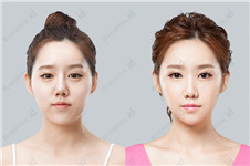 韩国V-line瓜子脸手术价格是多少？