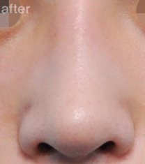 韩国三星梦（SamsungDream）整形医院歪鼻矫正案例对比图