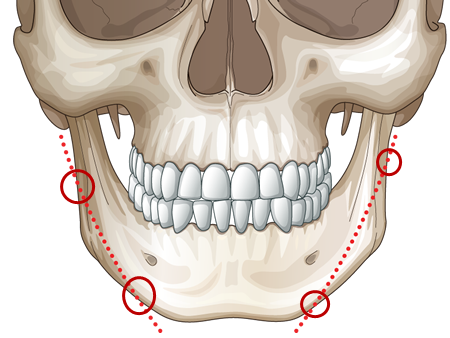 传统下颌角手术切割示意图